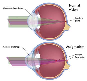 North Bergen Astigmatism