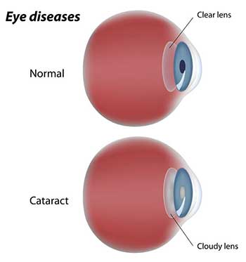 North Bergen Cataracts Exams