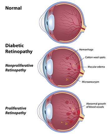 Diabetic Eye Problems North Bergen