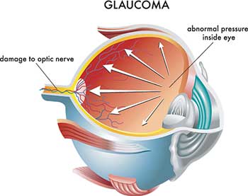 Glaucoma Testing North Bergen