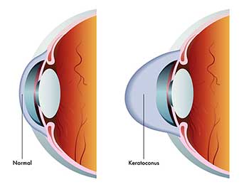 Keratoconus North Bergen