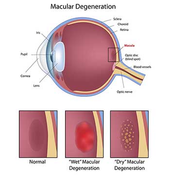 Macular Degeneration North Bergen