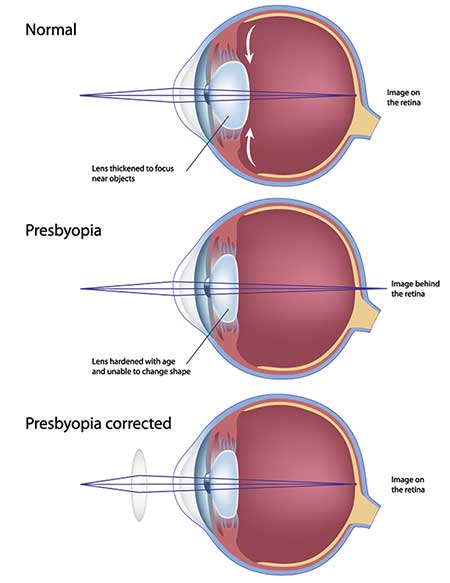 Presbyopia North Bergen