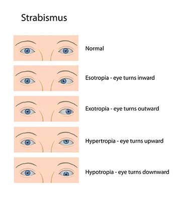 Strabismus North Bergen